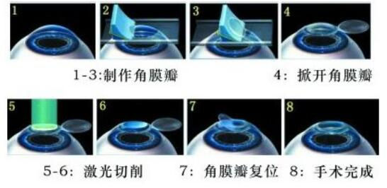 準(zhǔn)分子激光手術(shù)到底是怎么治 愈你的眼睛的？