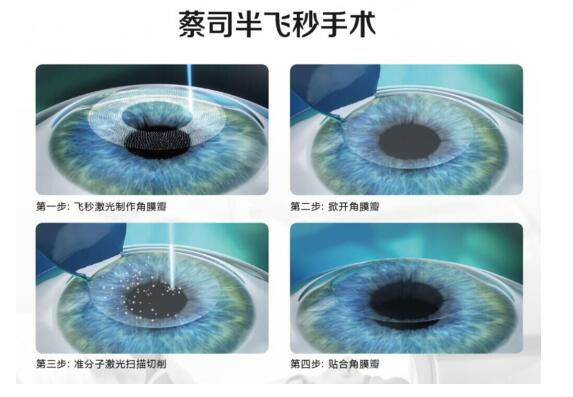 準(zhǔn)分子激光手術(shù)到底是怎么治 愈你的眼睛的？