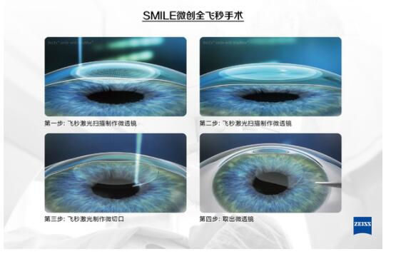 準(zhǔn)分子激光手術(shù)到底是怎么治 愈你的眼睛的？