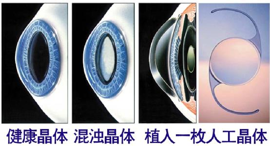 超聲乳化手術(shù)白內(nèi)障危險嗎？
