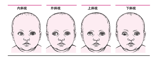 孩子有斜視做手術矯正有什么危險？
