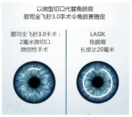 做完近視手術(shù)要休息多長時(shí)間？需要住院嗎？