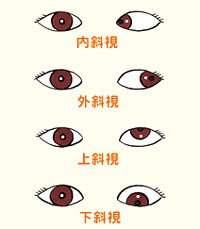看看兒童斜視眼病怎么預(yù)防？