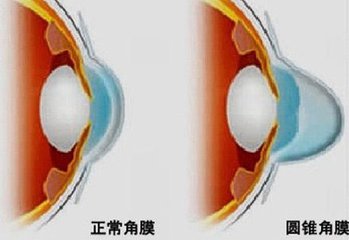 圓錐角膜，哪種角膜移植術(shù)好？