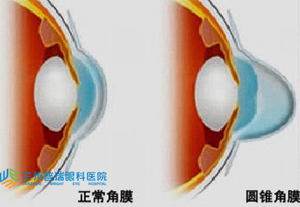 圓錐角膜怎樣？