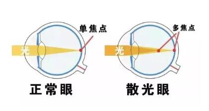 近視和散光，手術(shù)能同時矯正嗎？