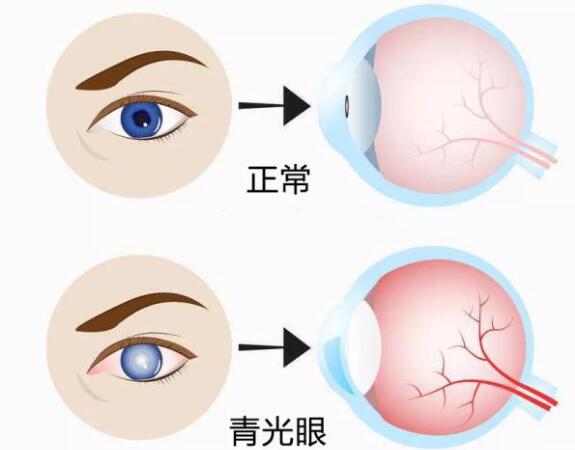 第17個(gè)青光眼周｜共管慢病青光眼，留得光明恒久遠(yuǎn)
